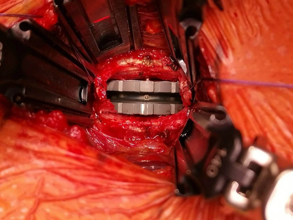 Lumbar disc arthroplasty replacement
