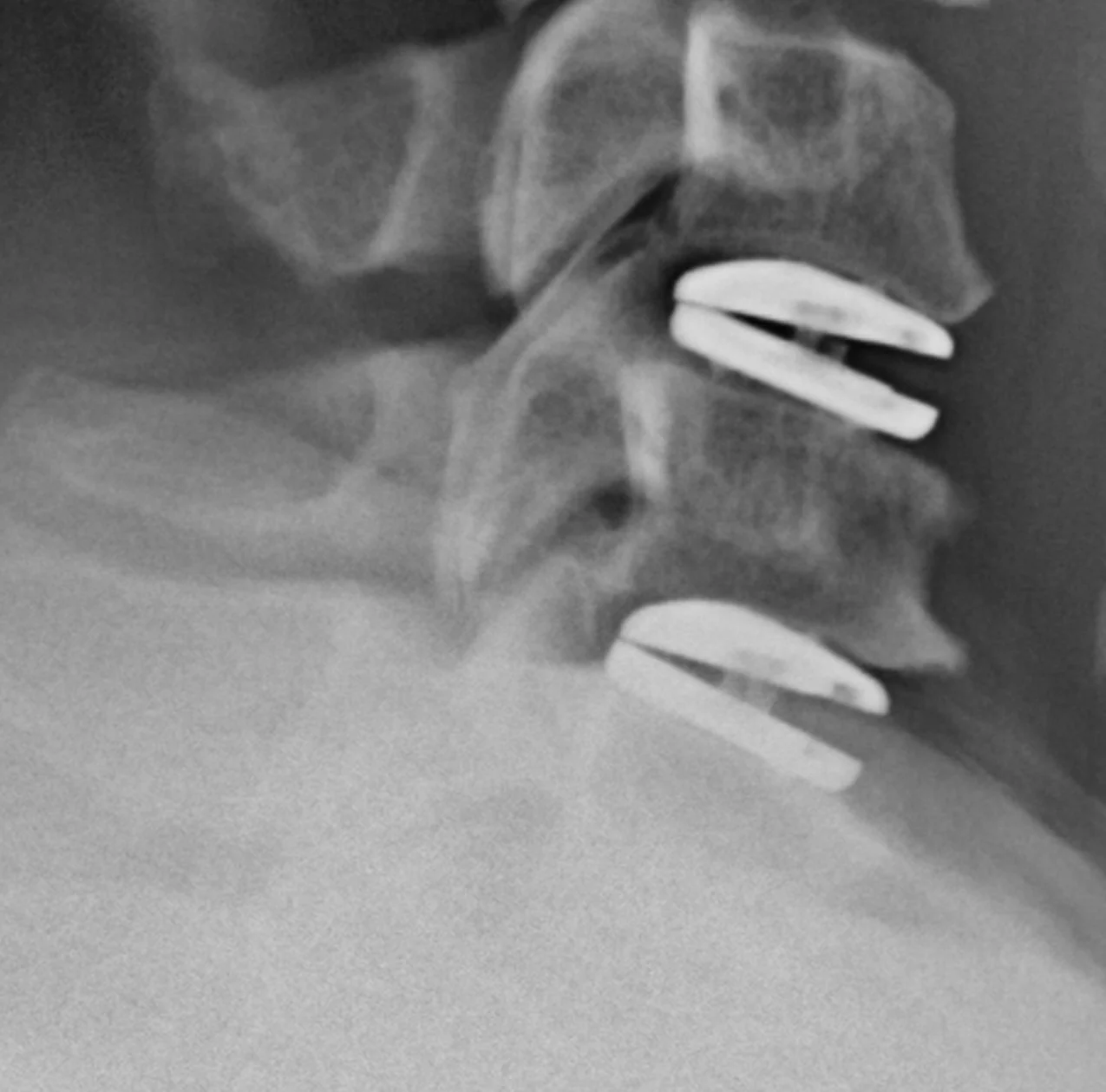 Cervical spine multilevel arthroplasty X-ray