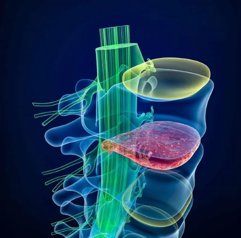Detailed anatomy of spine nerves and disc herniation